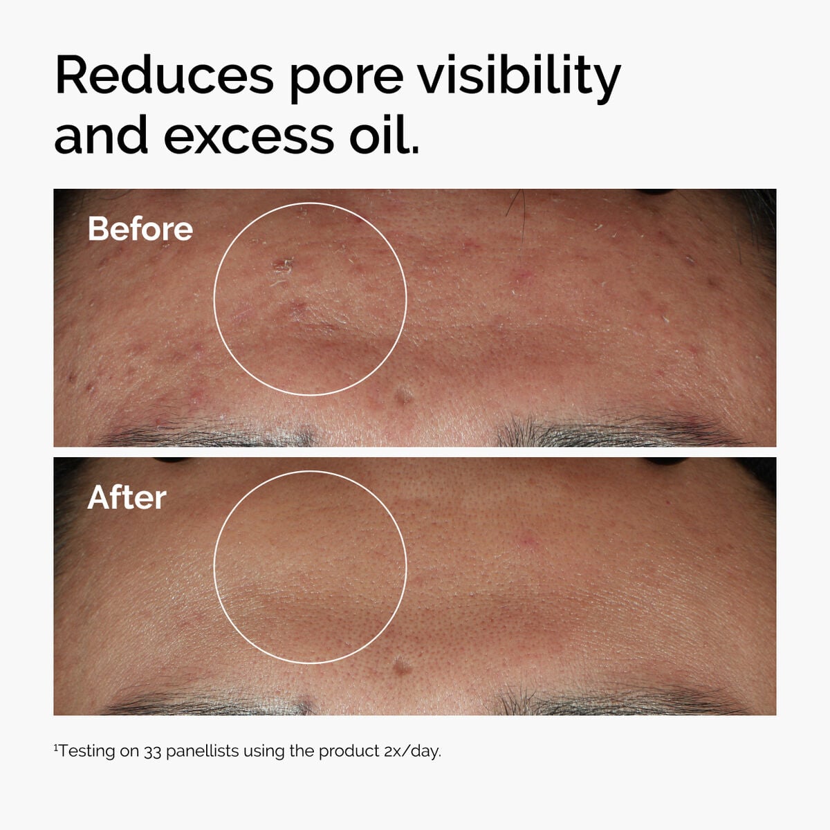 niacinamide-10-zinc-1-j9 ord-niacinamide-zinc-blemish-serum-before-after-pores.jpg