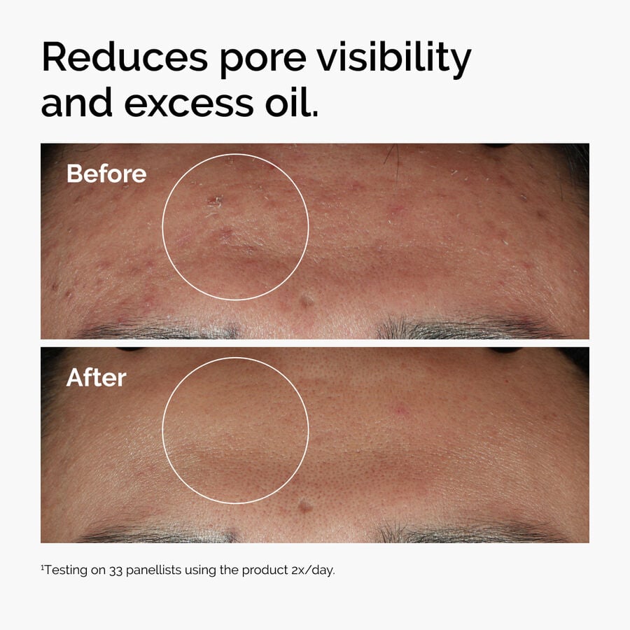 niacinamide-10-zinc-1-j9 ord-niacinamide-zinc-blemish-serum-before-after-pores.jpg