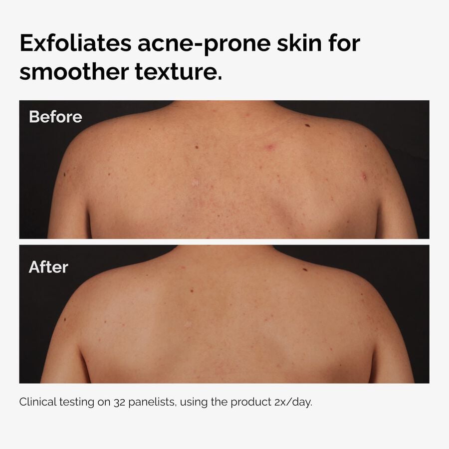 the-body-care-collection-w0 ord-salicylic-acid-body-serum-before-after-graphic-NA.jpg